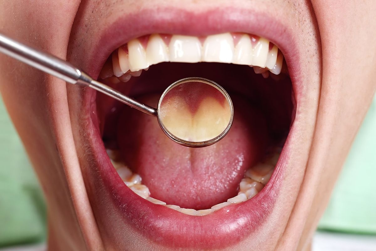 La reconocida infusión que eliminará las caries de tus dientes de forma definitiva La reconocida infusión que eliminará las caries de tus dientes de forma definitiva