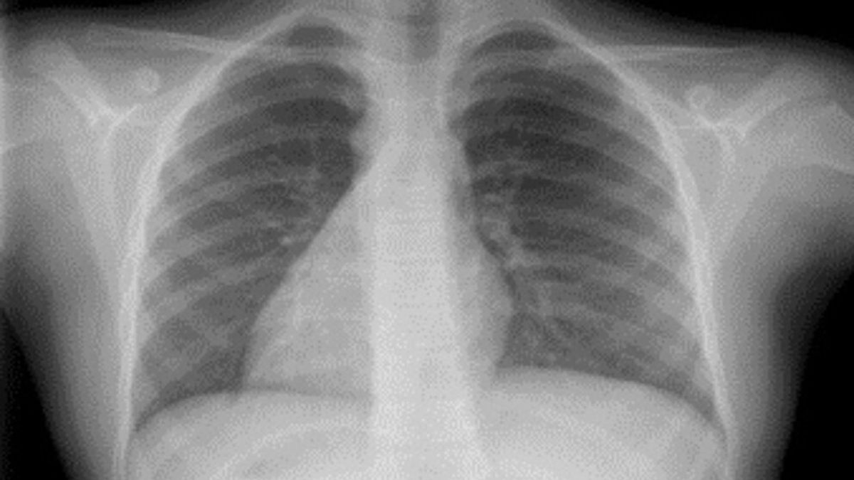 En esta anomalía, el corazón se encuentra en el lado derecho del cuerpo. 
