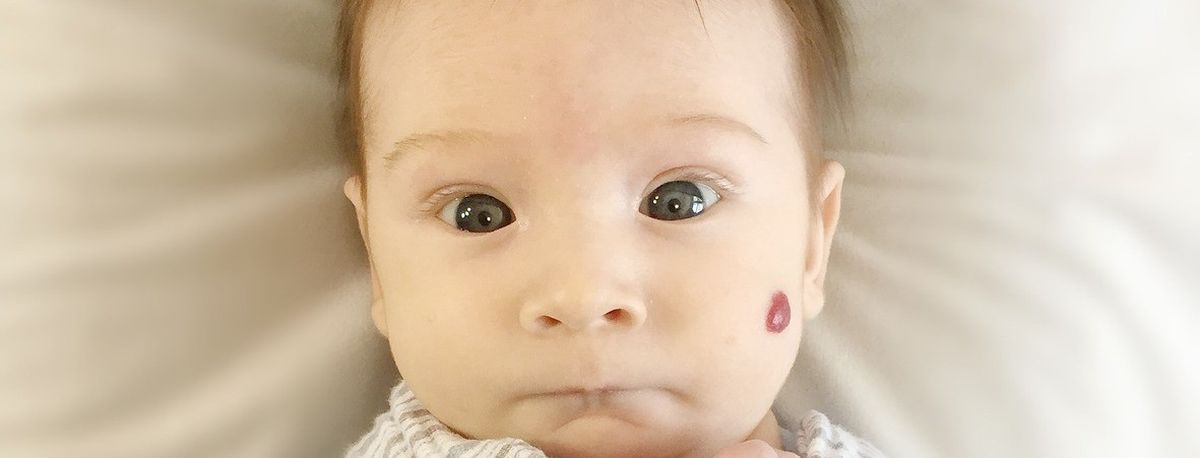 Marca de nacimiento. Marca de nacimiento.