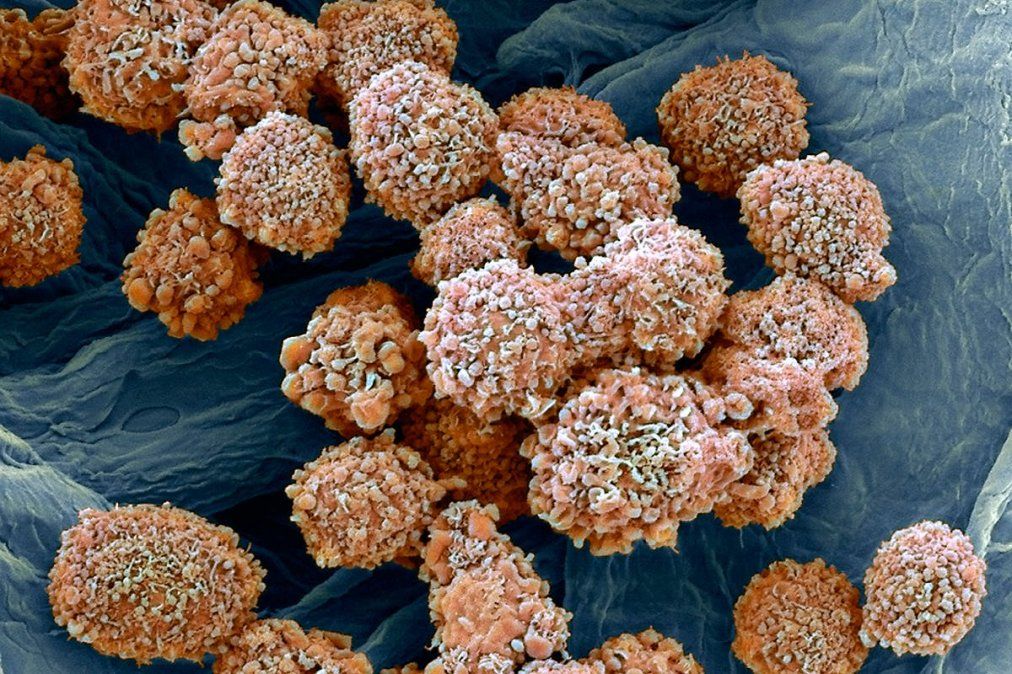 Cáncer de mama: primera causa de muerte por tumores en  mujeres
