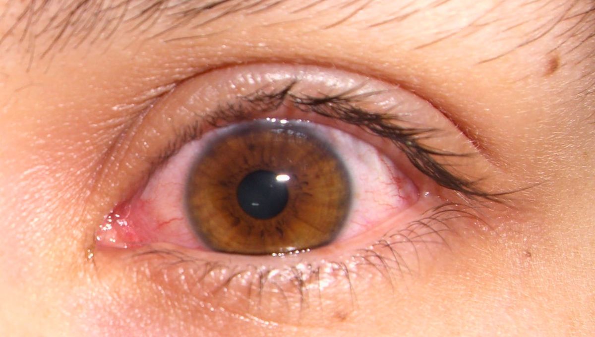 Estas luces, generalmente tienen forma de estrella y suelen ser reacciones que pueden ser naturales del ojo. Sin embargo, siempre hay que consultar con un médico. Estas luces, generalmente tienen forma de estrella y suelen ser reacciones que pueden ser naturales del ojo. Sin embargo, siempre hay que consultar con un médico.