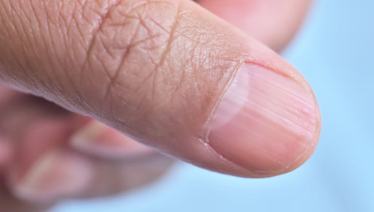 ¿Qué significan las rayas en las uñas?
