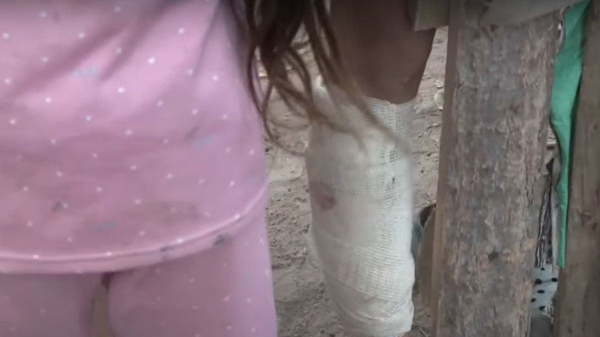 El niño herido por un perro en Las Heras mostró al móvil del Noticiero Siete su pierna, la que operaron en el hospital Notti. El niño herido por un perro en Las Heras mostró al móvil del Noticiero Siete su pierna, la que operaron en el hospital Notti.