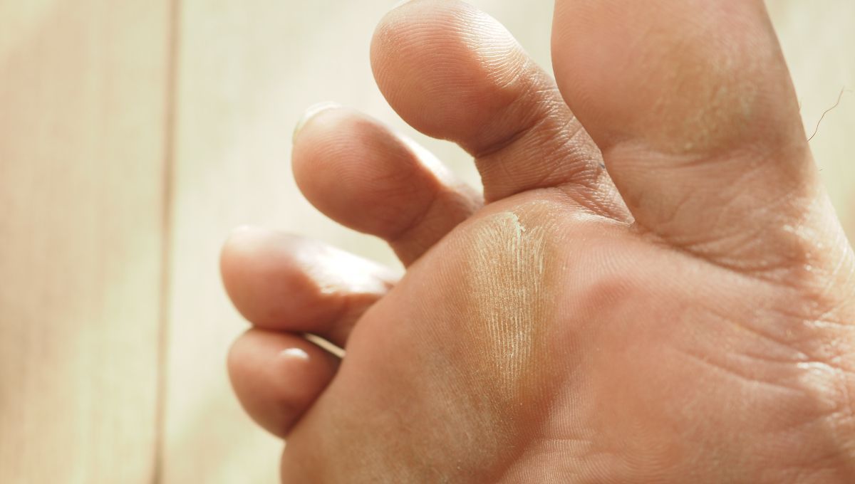 Pies secos y agrietados. Pies secos y agrietados.