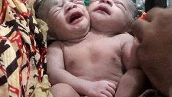 Nació con dos cabezas en Bangladesh y ya hablan de la “bebé milagro”