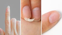 ¿Qué dicen tus uñas sobre tu salud?: quebradizas, amarillas, hundidas o con surcos