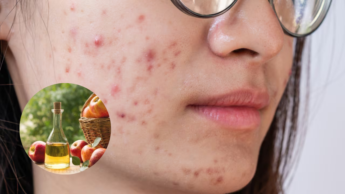 Este sencillo truco te ayudará a eliminar el acné de tu rostro.