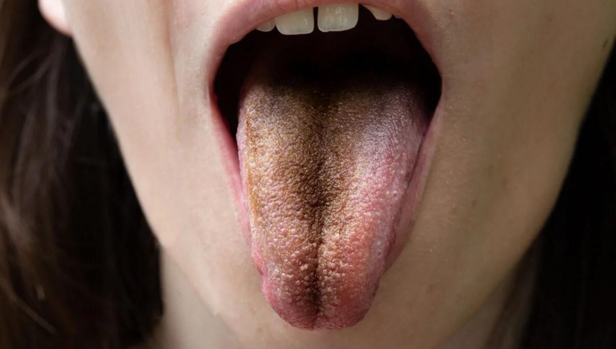 Manchas negras en la lengua: qué significan