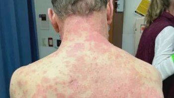 Así le dejó la piel un efecto raro de la vacuna Johnson & Johnson 