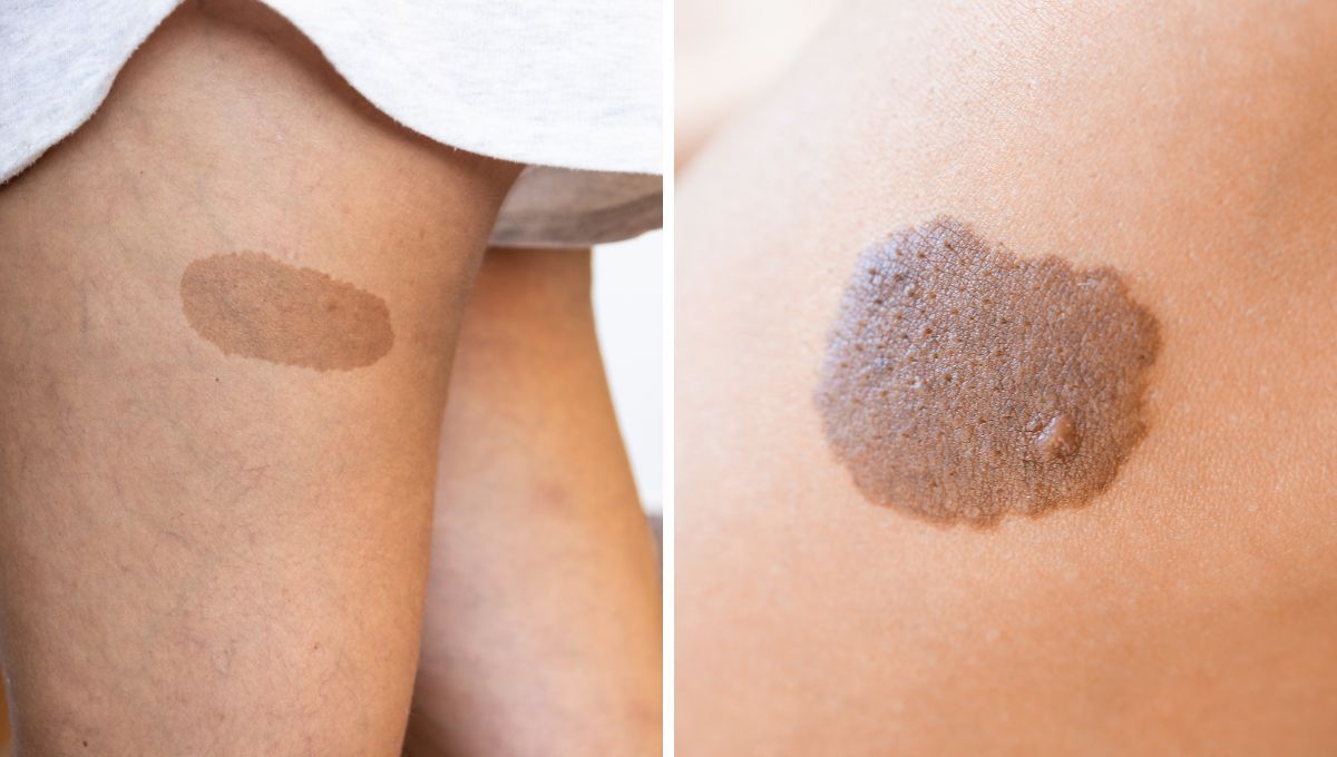 marcas de nacimiento marrones