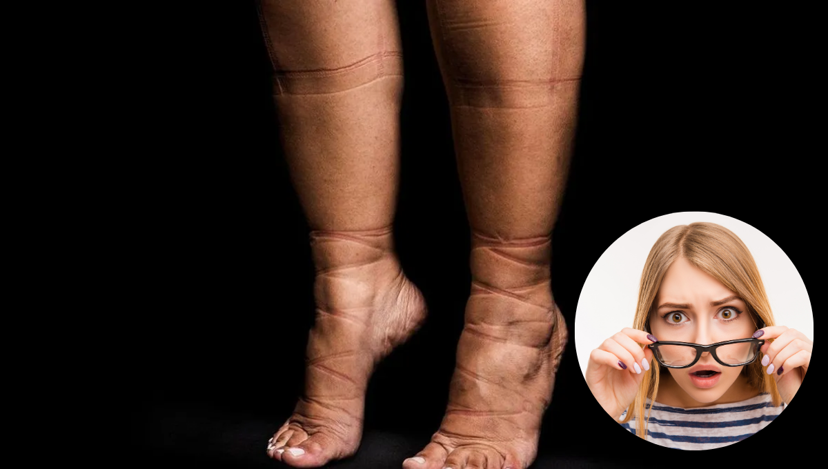 Qué significa que la ropa te deje marcas en la piel