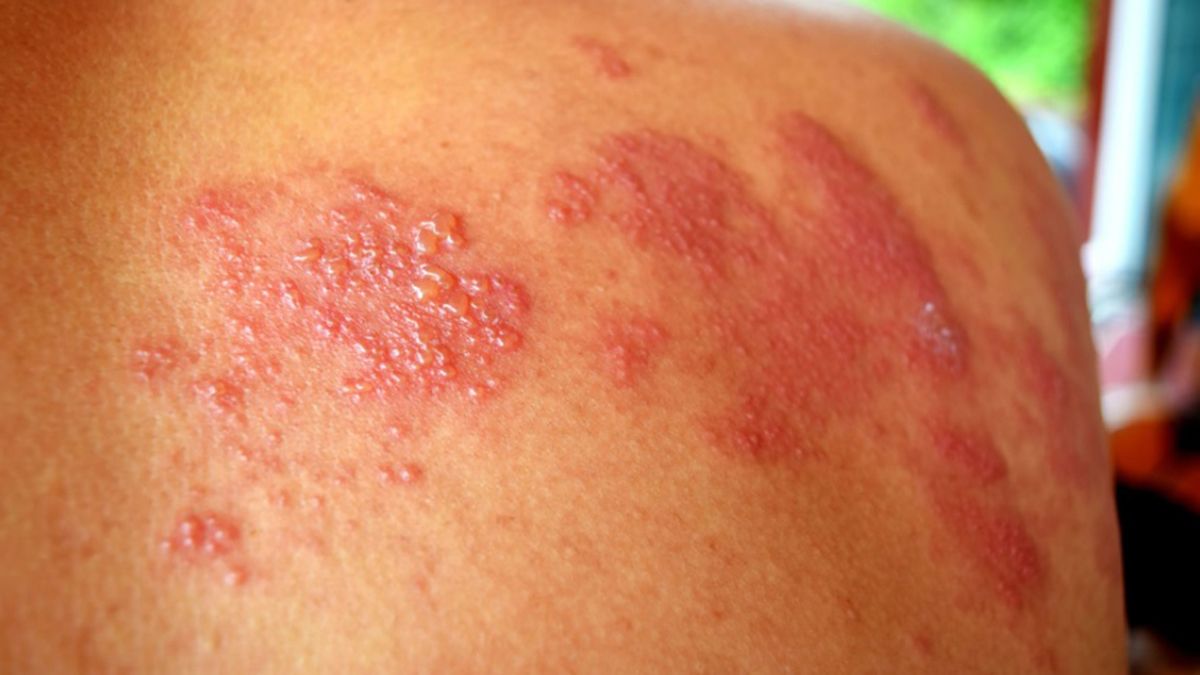 Herpes zóster: la infección que general preocupación médica y afecta más a adultos mayores
