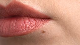 Qué significa tener un lunar en la cara o en el cuello Qué significa tener un lunar en la cara o en el cuello