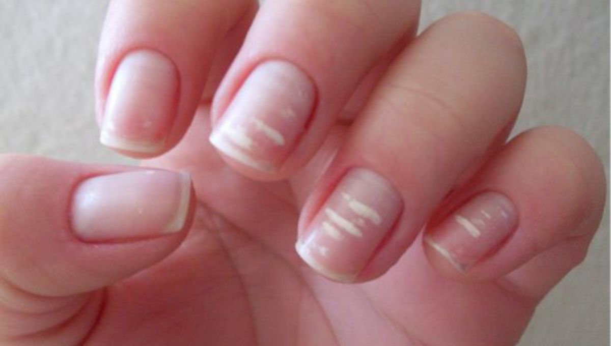 Qué pasa si me aparecen manchas blancas en las uñas y qué significa