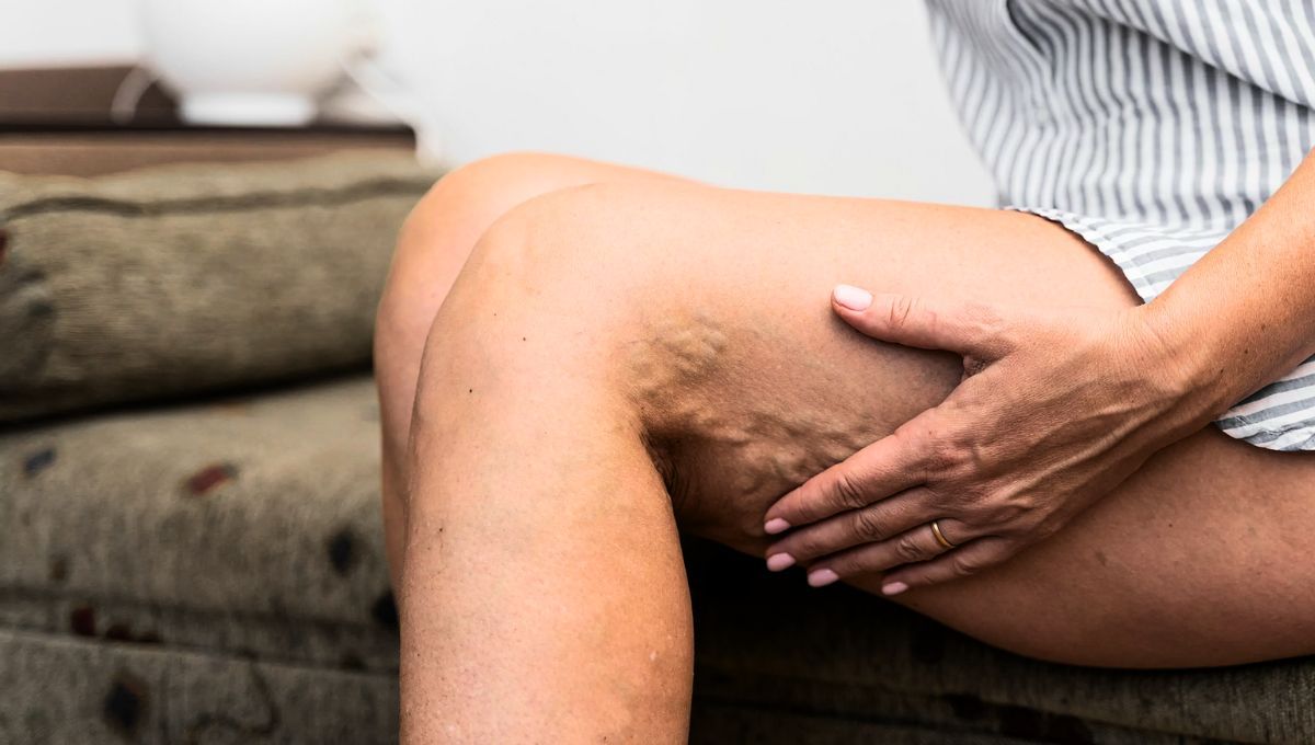 Las várices en adultos mayores pueden ser combatidas de manera casera