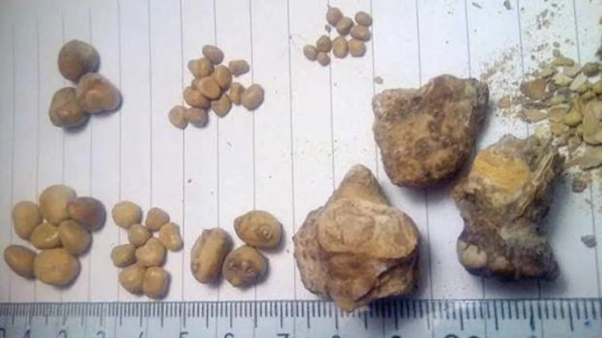 Tomaba 3 litros de Coca-Cola por día y le sacaron 35 piedras de la vejiga Tomaba 3 litros de Coca-Cola por día y le sacaron 35 piedras de la vejiga