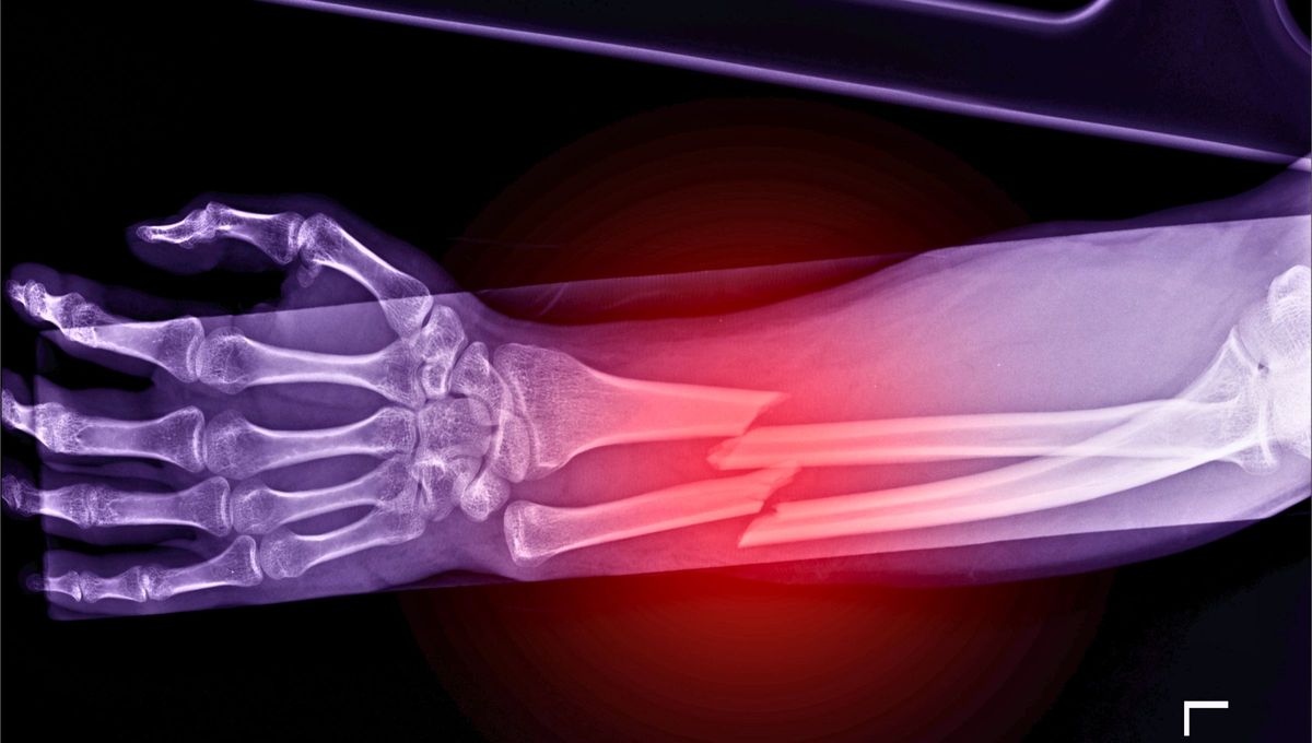 El estilo de vida influye enormemente en si sufrirás o no una fractura algún día. El estilo de vida influye enormemente en si sufrirás o no una fractura algún día. 