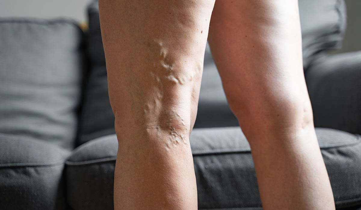 Dile adiós a las várices: el remedio natural que las oculta y mejora la circulación Dile adiós a las várices: el remedio natural que las oculta y mejora la circulación