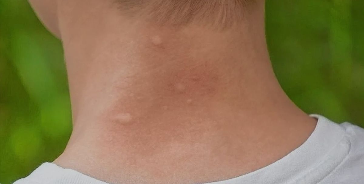 Los jejenes se han reportado mayormente en Buenos Aires. Los jejenes se han reportado mayormente en Buenos Aires. 