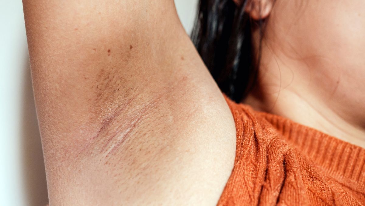 Axilas negras. Axilas negras. 