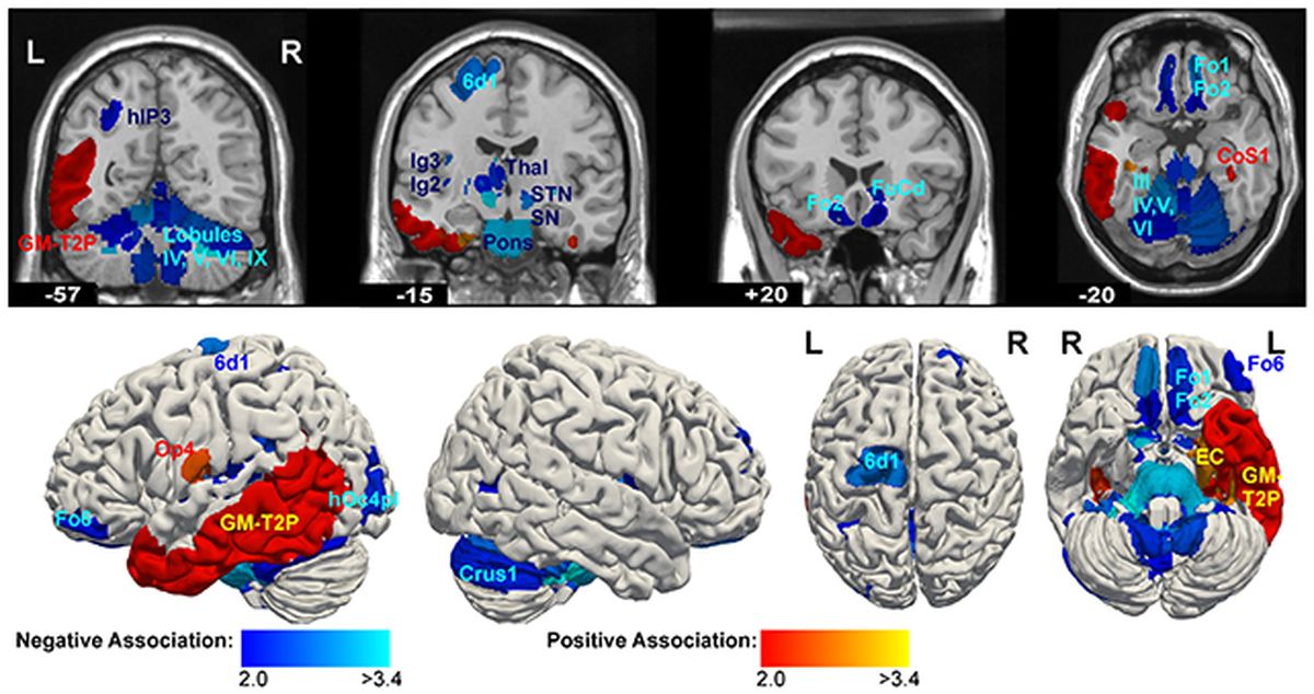 Las imágenes que los científicos utilizaron para estudiar los cerebros en el estudio. Las imágenes que los científicos utilizaron para estudiar los cerebros en el estudio.