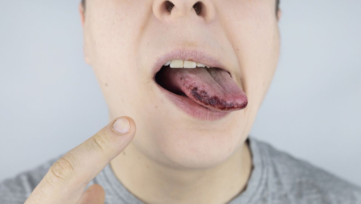 Lengua negra. Lengua negra.