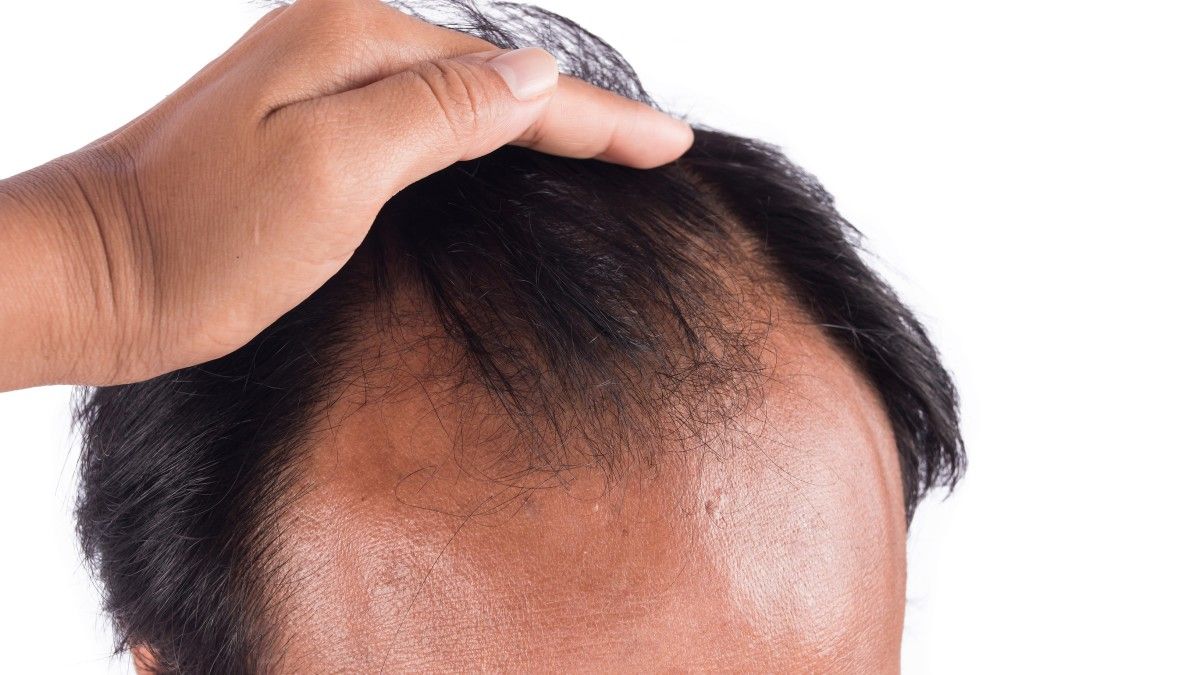 La alopecia del efluvio tel & oacute; geno est & aacute; asociada al estr & eacute; s
