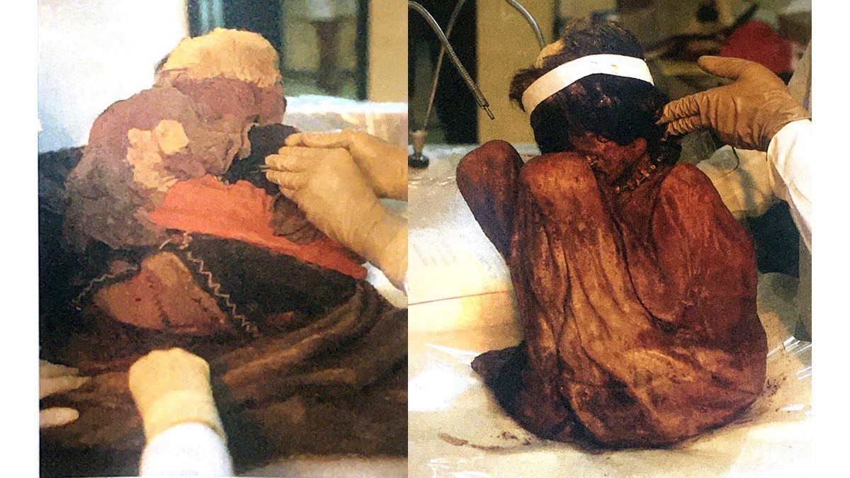 La momia del Aconcagua durante la autopsia. Se supo que había muerto por fractura de cráneo.