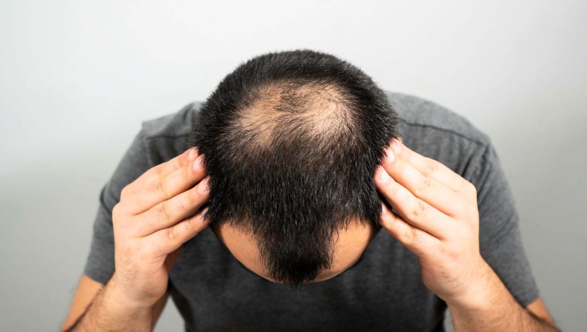 Descubrimiento de una posible cura para la calvicie en apenas 20 días sorprende a los especialistas