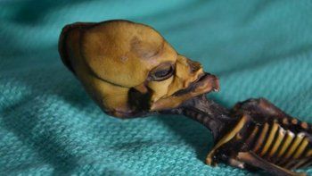 El esqueleto de Atacama era una niña con una enfermedad ósea