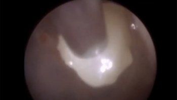 Video: extrajeron un diente del oído de un niño