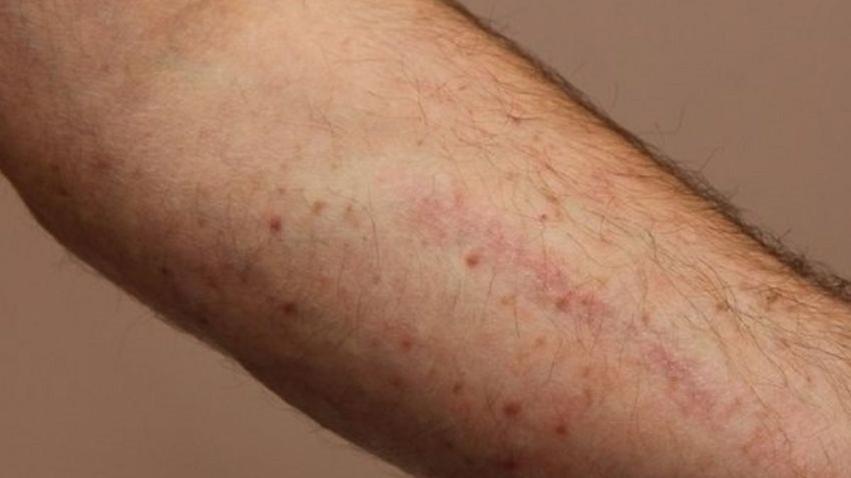 La aparición de ronchas o hematomas en el cuerpo pueden representar un llamado de atención para los pacientes La aparición de ronchas o hematomas en el cuerpo pueden representar un llamado de atención para los pacientes