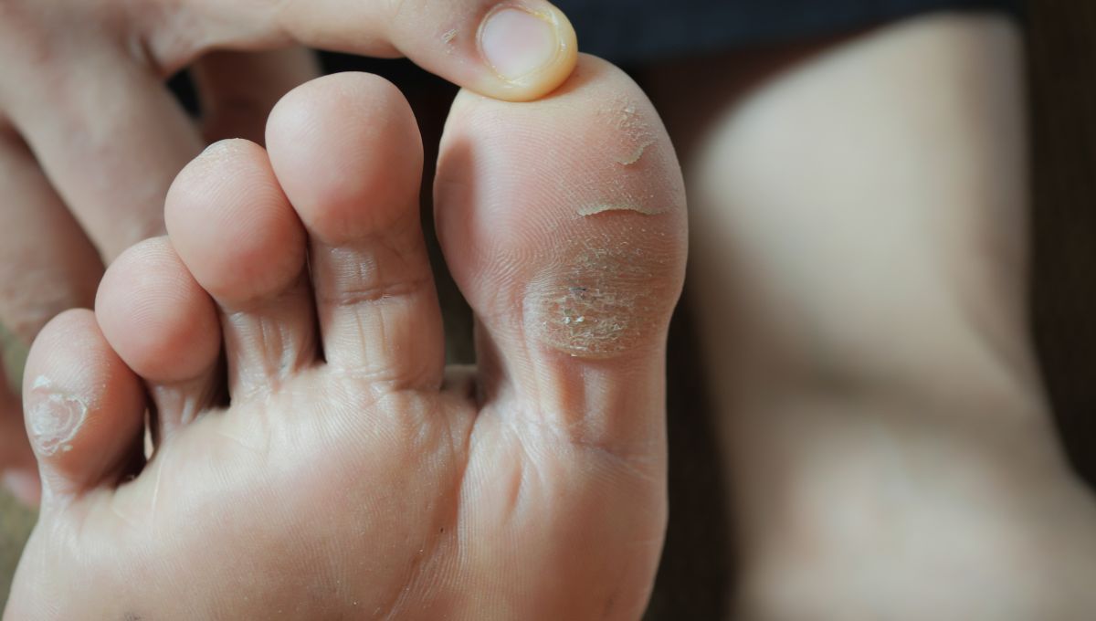Pies secos y agrietados: ¿qué significa y qué problema de salud advierte?