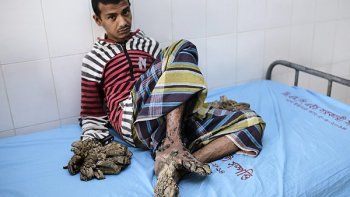 Médicos bangladesíes intentarán operar al 