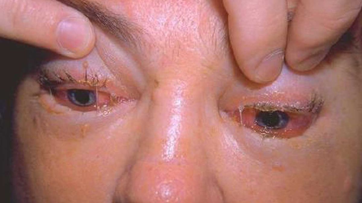 Uno de los síntomas más frecuentes de la triquinosis es la inflamación de los párpados Uno de los síntomas más frecuentes de la triquinosis es la inflamación de los párpados