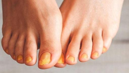 Dile adiós para siempre a los hongos de las uñas de tus pies&nbsp;