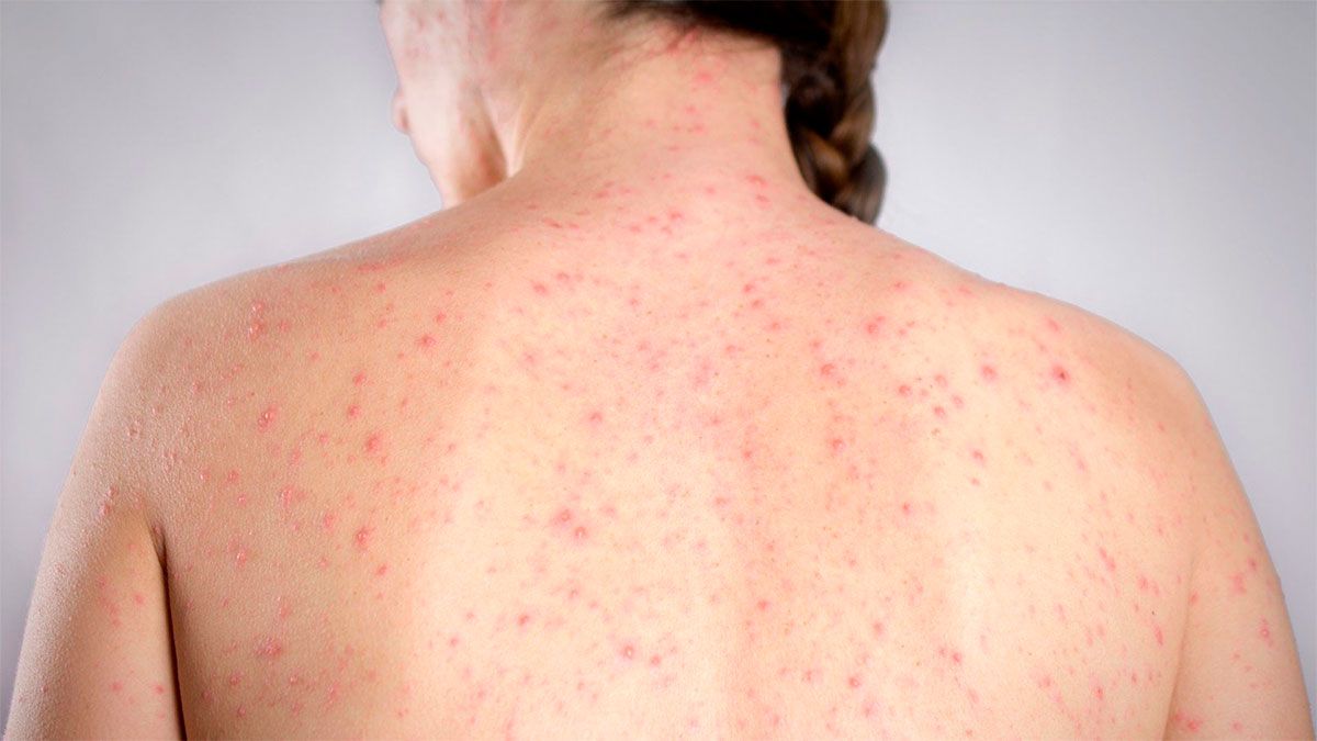 Una mujer adulta con sarampión. En Argentina reapareció el virus en febrero con 4 casos confirmados en la Ciudad de Buenos Aires. Una mujer adulta con sarampión. En Argentina reapareció el virus en febrero con 4 casos confirmados en la Ciudad de Buenos Aires.