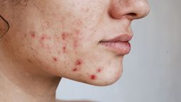 Rutina de skincare para tratar problemas de acné