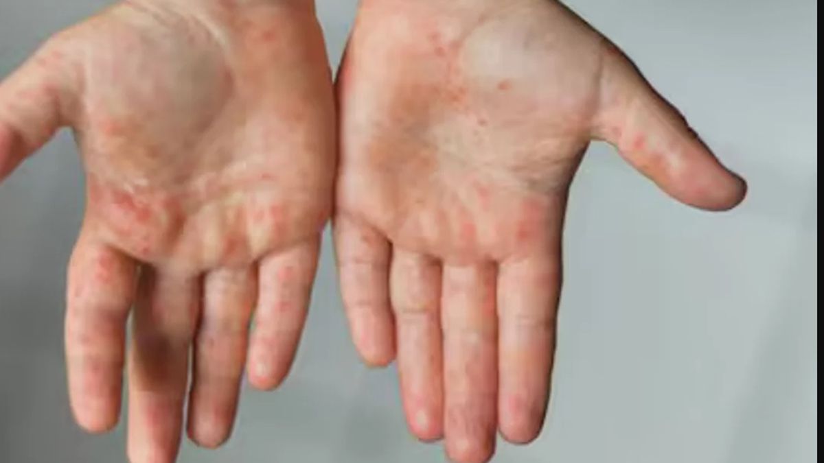 Viruela del mono: se detectaron más de 20 casos en 2024 en la Argentina