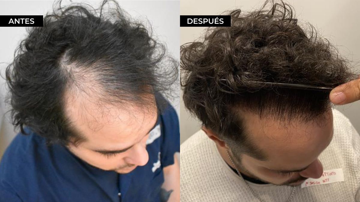 Los resultados del microtrasplante capilar pelo por pelo son sumamente naturales. Los resultados del microtrasplante capilar pelo por pelo son sumamente naturales.