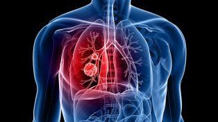 Aprobaron un tratamiento para el cáncer de pulmón que triplica la supervivencia